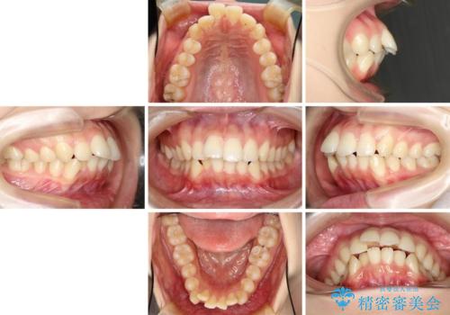 目立たない裏側装置 ハーフリンガルの抜歯矯正の治療前