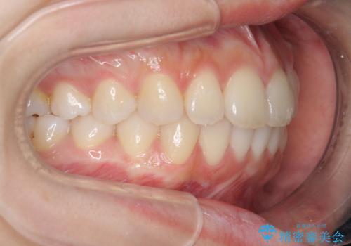 [ インビザライン ]  前歯のがたつきを綺麗に並べたいの治療後
