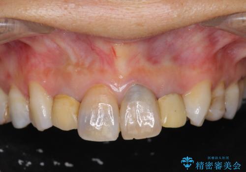 黒ずんだ見栄えの悪い前歯をきれいにしたいの治療前