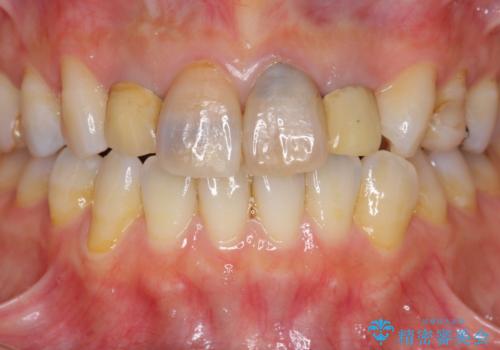 黒ずんだ見栄えの悪い前歯をきれいにしたいの治療前