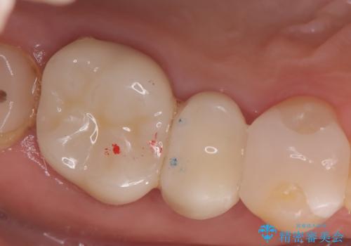 【セラミックインレー】フロスを通すと血が出て臭うの治療後