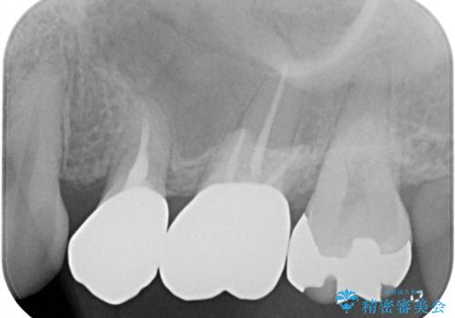 二次う蝕が心配の治療前