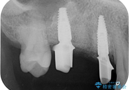 失った奥歯を、インプラント治療で機能回復の治療中