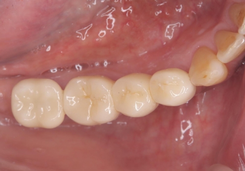 被せ物がとれた オールセラミックによるブリッジ治療の治療後