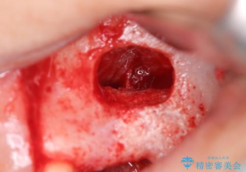 予後の悪い歯を抜歯 インプラントでの治療の治療中