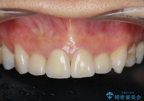 黒ずんだ見栄えの悪い前歯をきれいにしたいの治療後