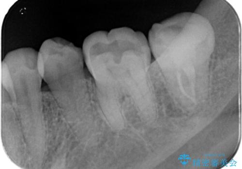 樋状根(といじょうこん)の根管治療の治療後