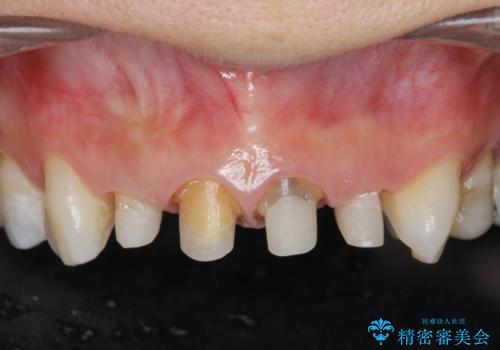 黒ずんだ見栄えの悪い前歯をきれいにしたいの治療中