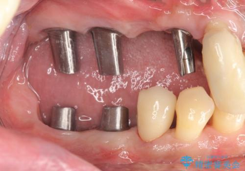 インプラント・ブリッジ補綴を含む、歯周病全顎治療の治療中