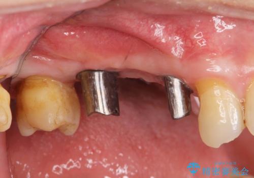 失った奥歯を、インプラント治療で機能回復の治療中