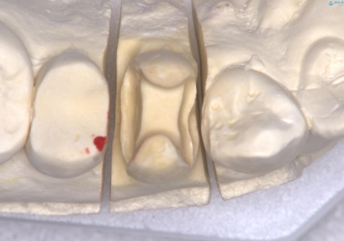 【セラミックインレー】フロスを通すと血が出て臭うの治療後