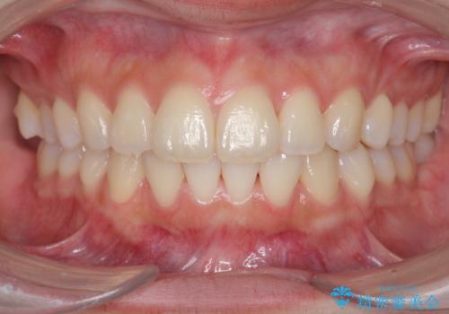 [ インビザライン ]  前歯のがたつきを綺麗に並べたいの治療後