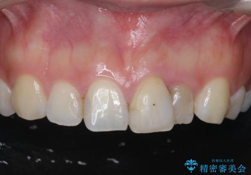 [ セラミック治療 ]  前歯の変色をきれいにしたいの治療前