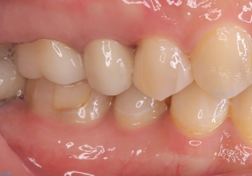【セラミックインレー】フロスを通すと血が出て臭うの治療後