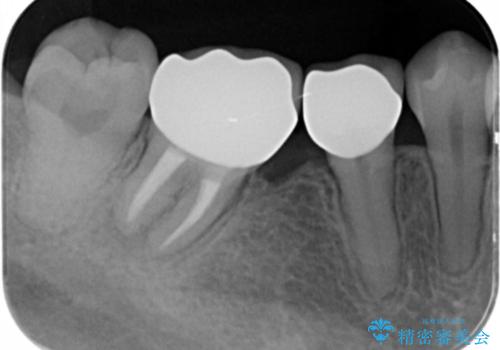 [ ジルコニアクラウン ]  銀歯を外して白くしたいの治療後