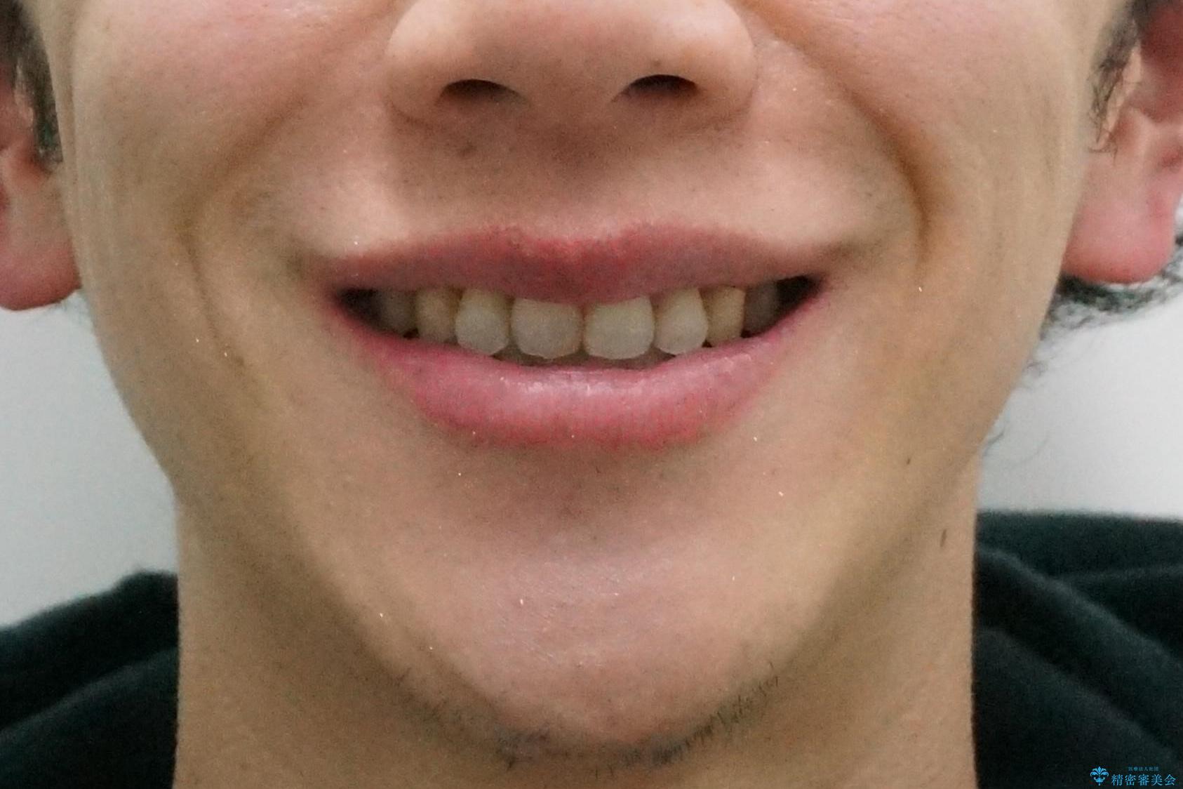出っ歯をしっかり引っ込めたいの治療後(顔貌)