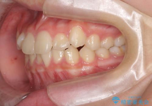 [ 前歯のねじれ改善 ]   中学生に行う早期マウスピース矯正治療の治療前
