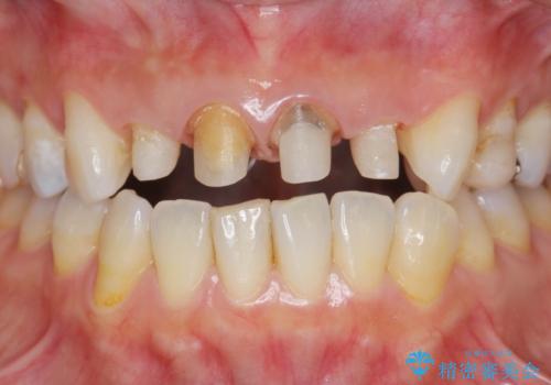 黒ずんだ見栄えの悪い前歯をきれいにしたいの治療中