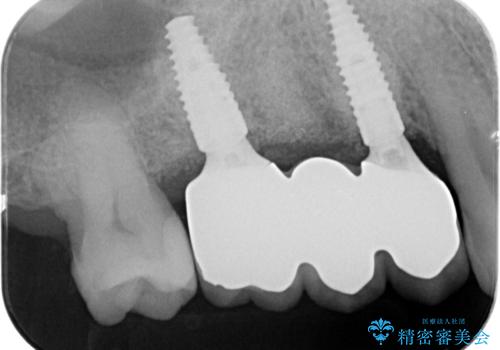 失った奥歯を、インプラント治療で機能回復の治療後