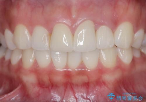 [ セラミック治療 ]  前歯の変色をきれいにしたいの治療後
