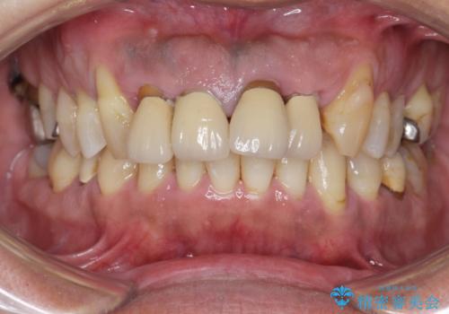 インプラント・ブリッジ補綴を含む、歯周病全顎治療の治療前