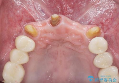 インプラント・ブリッジ補綴を含む、歯周病全顎治療の治療中