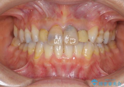 黒ずんだ見栄えの悪い前歯をきれいにしたいの治療前