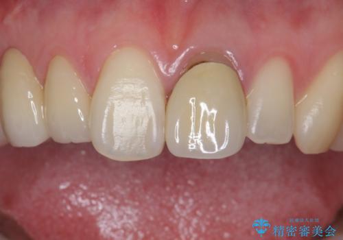 前歯を綺麗にしたい ジルコニアクラウンでの治療の治療前