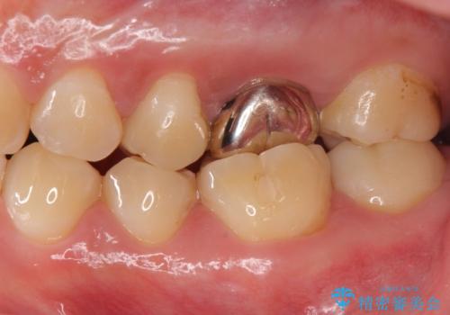 不適合な被せ物 ジルコニアクラウンでの再治療の治療前