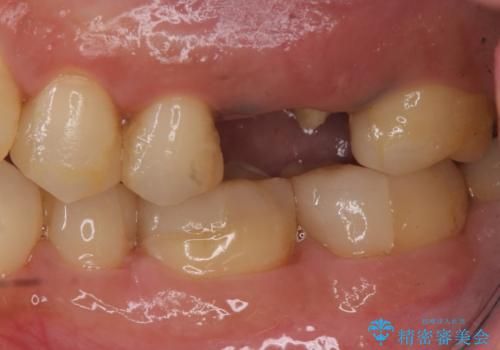 予後の悪い歯を抜歯 インプラントでの治療の治療前