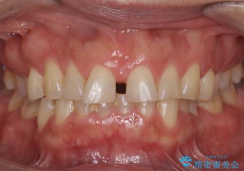 50代女性　部分矯正で　前歯の見た目改善　気になるところだけの治療前