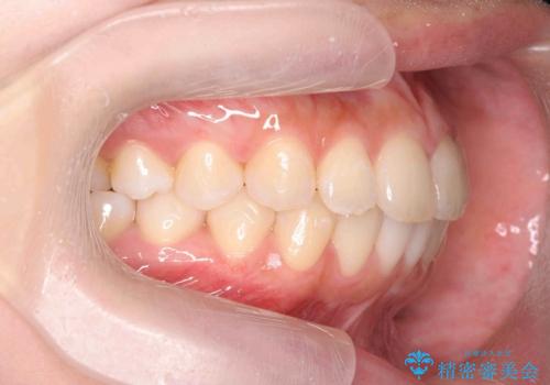 [ インビザライン ]  前歯のがたつきを綺麗に並べたいの治療中