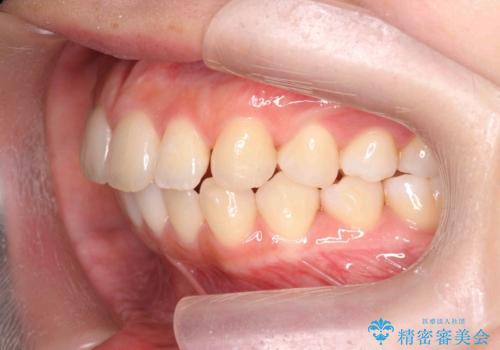 [ インビザライン ]  前歯のがたつきを綺麗に並べたいの治療中