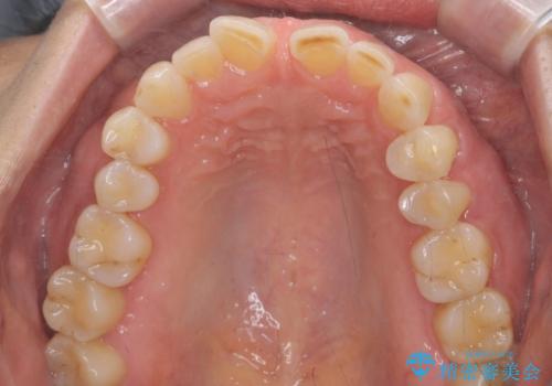 50代女性 部分矯正で 前歯の見た目改善 気になるところだけの治療前