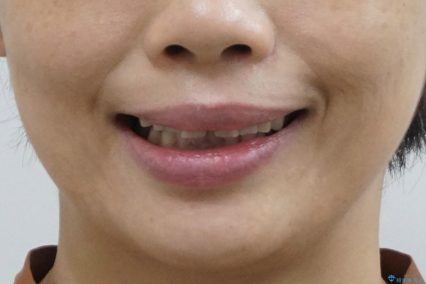 50代女性 部分矯正で 前歯の見た目改善 気になるところだけの治療前(顔貌)