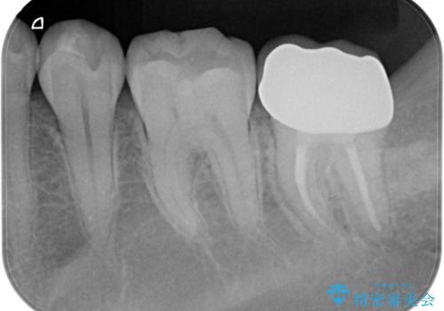他院での治療に不信感 虫歯除去後のジルコニアクラウンの治療後