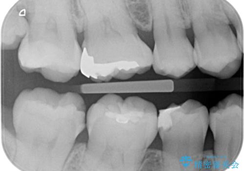 歯に食べ物が詰まる。の治療前