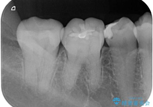 歯に食べ物が詰まる。の治療後