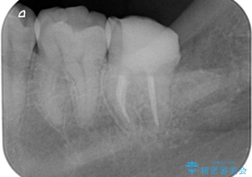 他院での治療に不信感 虫歯除去後のジルコニアクラウンの治療中