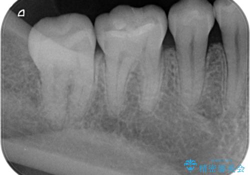 古い樹脂の劣化 セラミックインレー治療の治療後