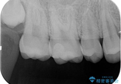 歯と歯の間の虫歯 e-maxインレーで修復の治療後