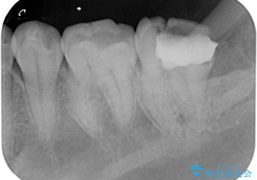 他院での治療に不信感 虫歯除去後のジルコニアクラウンの治療前