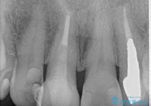 モザイク模様の前歯 オールセラミッククラウンで整った印象にの治療前