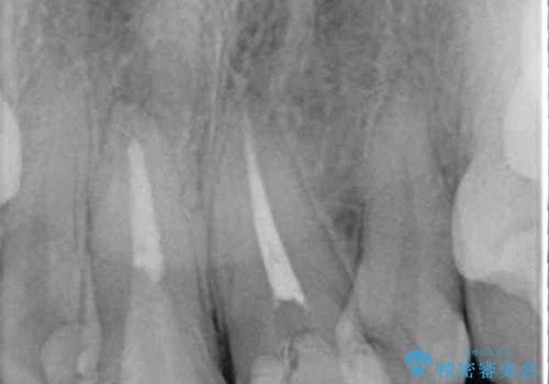変色したバランスの悪い前歯をオールセラミッククラウンで自然な口元にの治療前