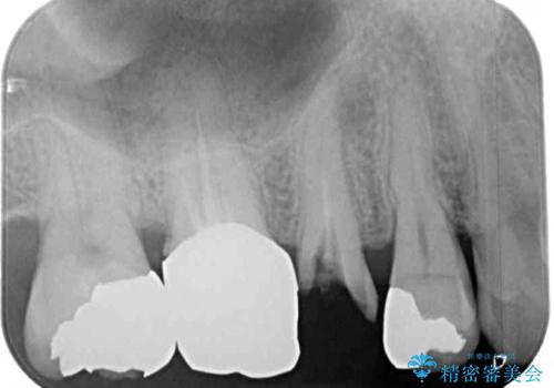 もげてしまった奥歯 オールセラミッククラウンでの補綴治療