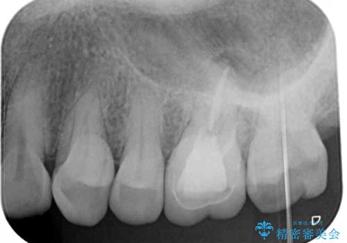 境目にものが詰まって気になる オールセラミッククラウン治療の治療前