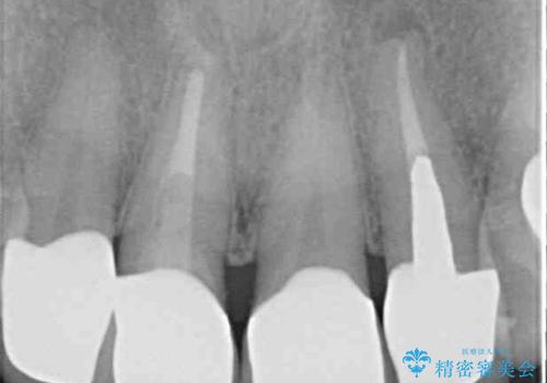 モザイク模様の前歯 オールセラミッククラウンで整った印象にの治療後