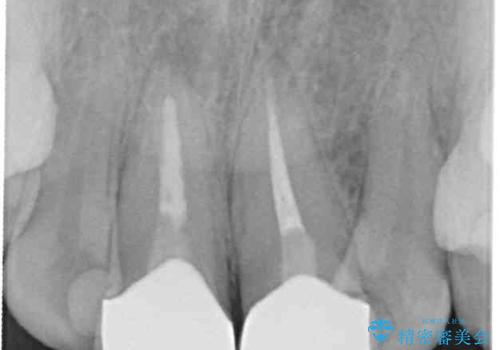 変色したバランスの悪い前歯をオールセラミッククラウンで自然な口元にの治療後