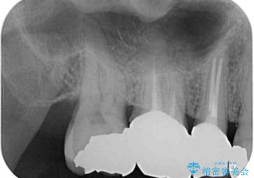 もげてしまった奥歯 オールセラミッククラウンでの補綴治療の治療後