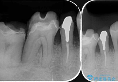 インプラント・ブリッジ補綴を含む、歯周病全顎治療の治療前